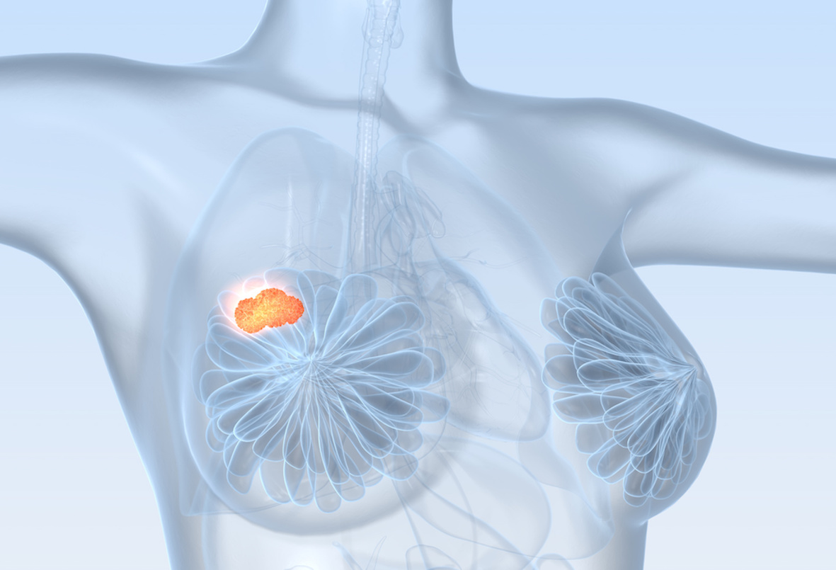 Breast cancer: the role of slow-dividing cells in late recurrence